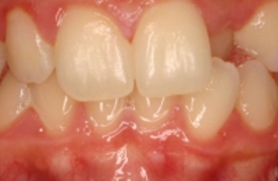 Croppedimage330130 Cross Bite B4