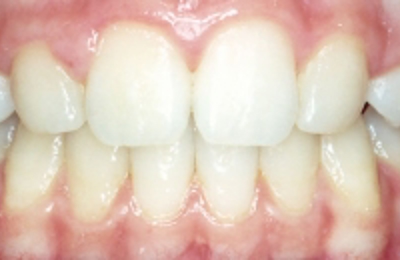 Croppedimage330130 Missing Teeth After