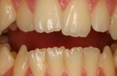 Croppedimage330130 Open Bite B4