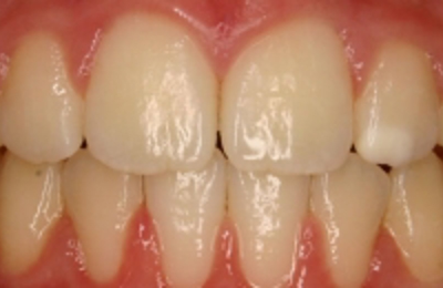 Croppedimage330130 Prominent Teeth Centre After