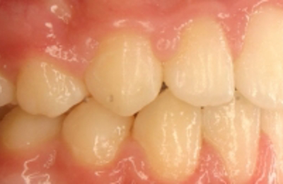 Croppedimage330130 Prominent Teeth Profile After