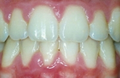 Croppedimage330130 Under Bite After