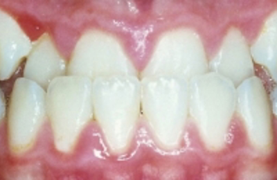 Croppedimage330130 Under Bite B4